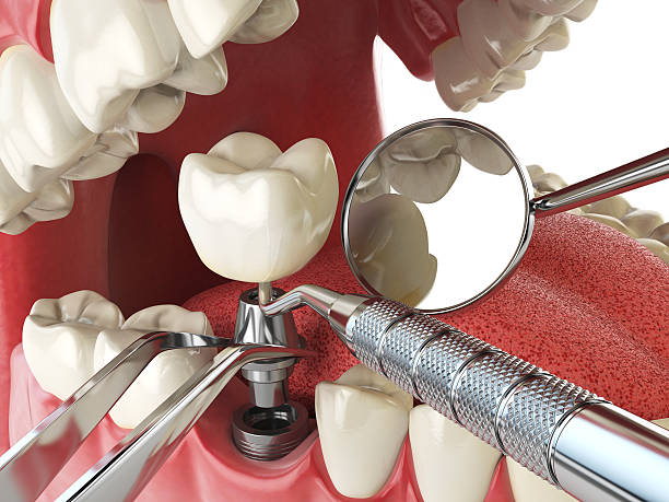 Best Broken or Chipped Tooth Repair in Ashley, OH